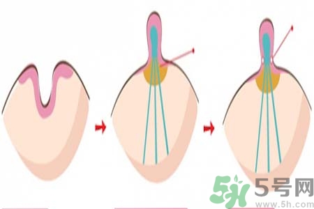 乳头内陷矫正需注意什么？乳头内陷如何预防？