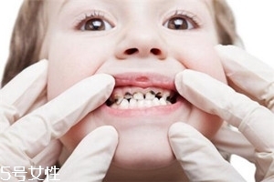 宝宝龋齿常有哪些问题？龋齿问题需注意