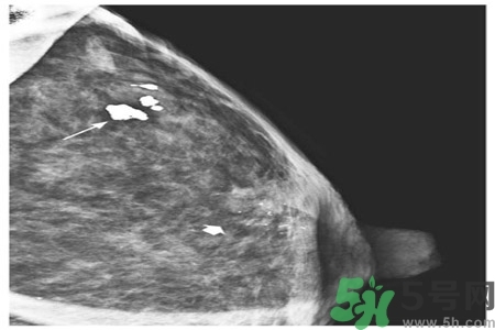 乳腺增生钙化是什么？乳腺钙化的症状有哪些？