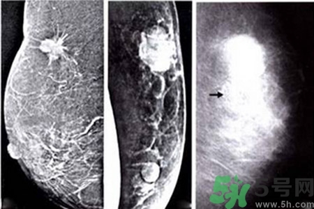 乳腺增生钙化是什么？乳腺钙化的症状有哪些？