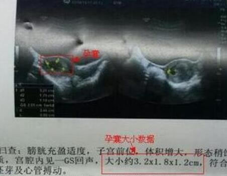 
	孕期孕囊形状看男女(超准)，长条是男宝/圆形是女宝
