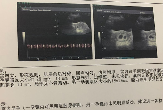 
	双胞胎和龙凤胎B超图区别(龙凤胎B超4大特征)
