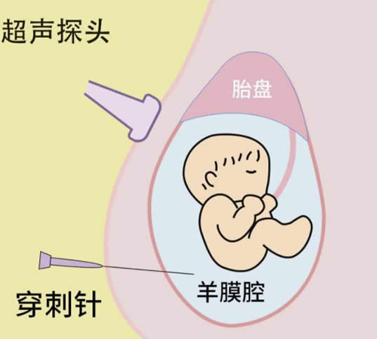 
	羊水穿刺5天后伤口图片 还有没有影响呢(孕妇羊穿检查流程)
