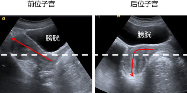 
	子宫前位和子宫后位图片区别 哪个比较容易受孕
