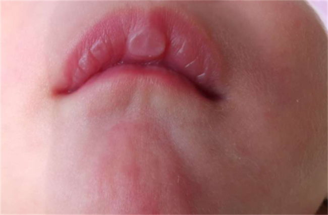 婴儿嘴唇起白点怎么办3种处理方法让妈妈们别担心 