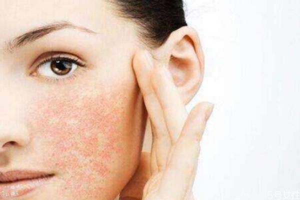 敏感肌肤的特征 敏感性皮肤修复方法