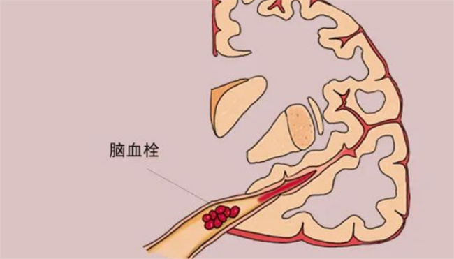 ​ 得了脑血栓能治愈吗 得了脑血栓有什么症状 