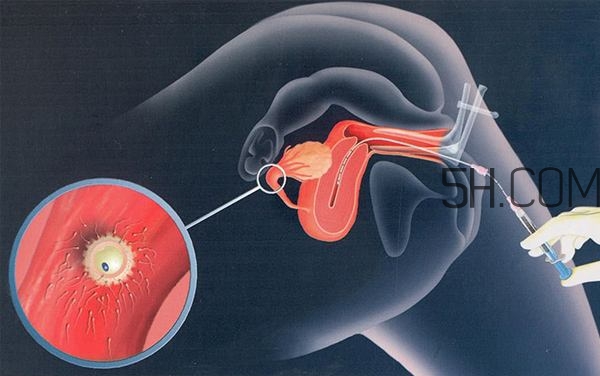 人工授精取卵子怎么取？人工授精男人怎样取精？