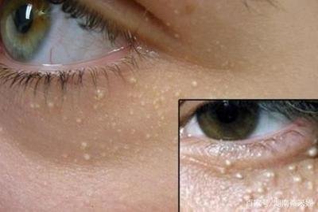 用眼霜为什么会长脂肪粒？眼部长脂肪粒的原因有哪些？